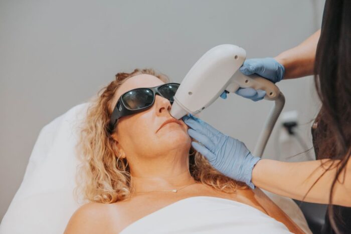 Laser Hair Removal on the Upper Lip