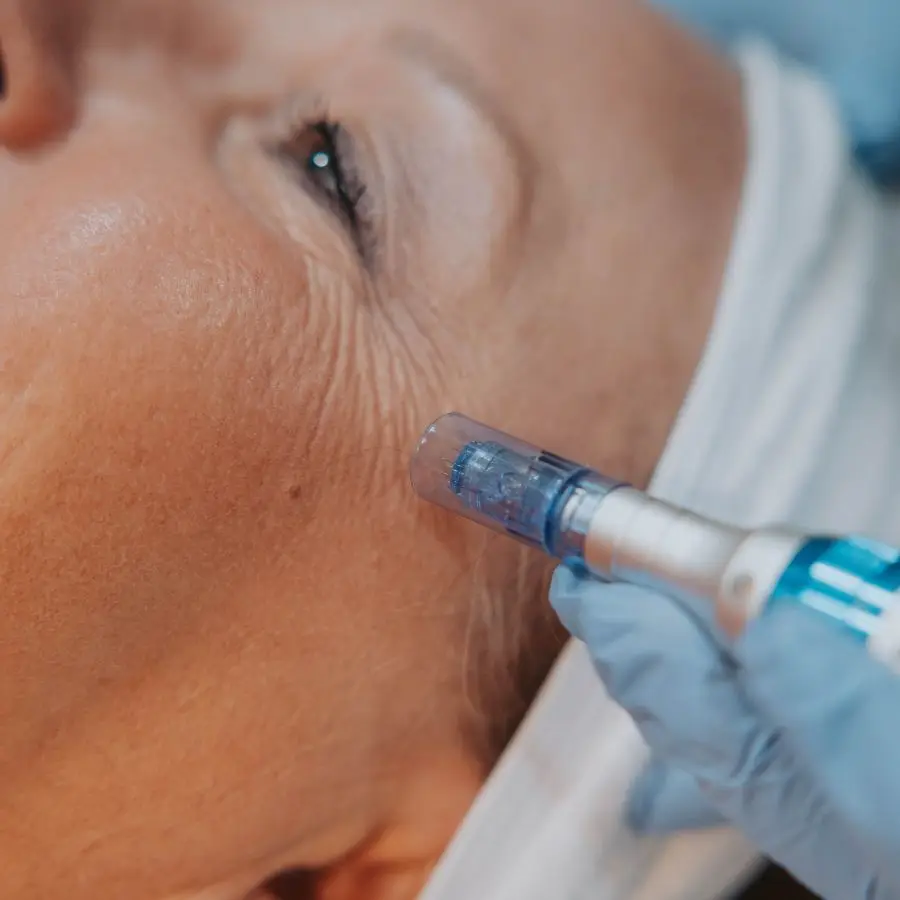 Microneedling Fine Lines Near Eyes