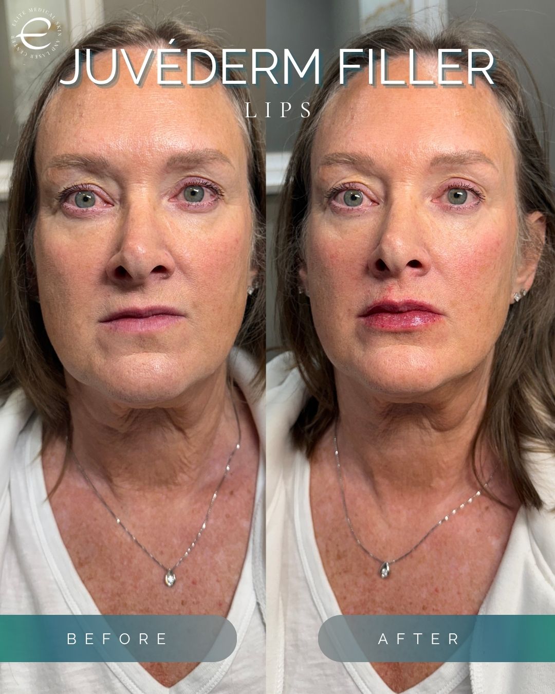 Client at Elite before and after her Juvederm Filler in her lips