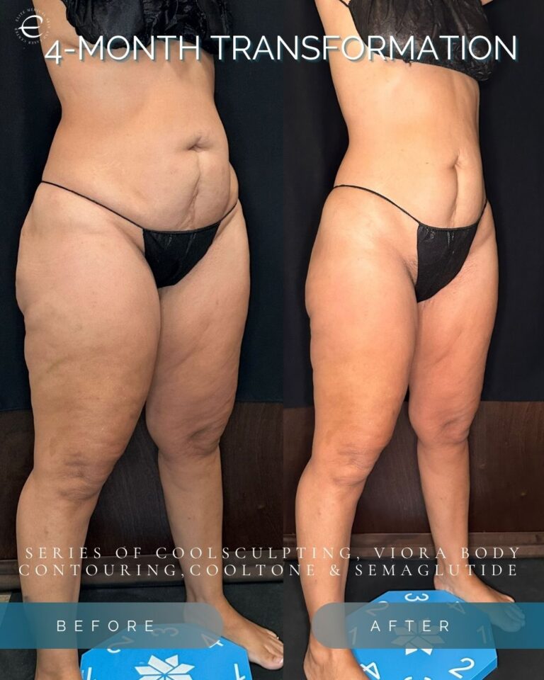 CoolSculpt B4&A